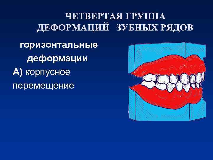 ЧЕТВЕРТАЯ ГРУППА ДЕФОРМАЦИЙ ЗУБНЫХ РЯДОВ горизонтальные деформации А) корпусное перемещение 