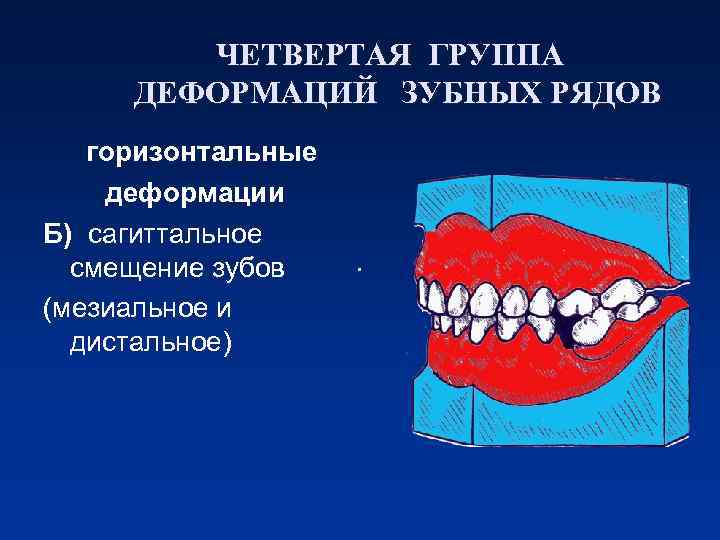 ЧЕТВЕРТАЯ ГРУППА ДЕФОРМАЦИЙ ЗУБНЫХ РЯДОВ горизонтальные деформации Б) сагиттальное смещение зубов (мезиальное и дистальное)