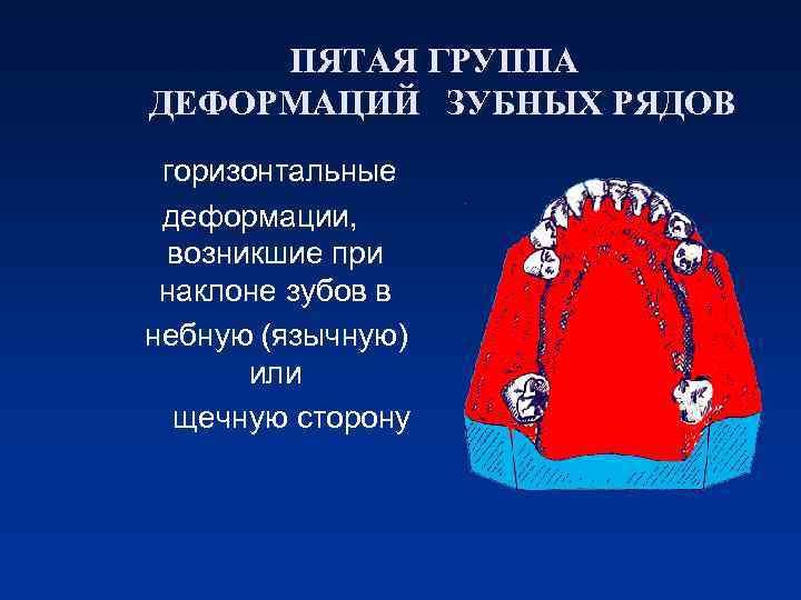 ПЯТАЯ ГРУППА ДЕФОРМАЦИЙ ЗУБНЫХ РЯДОВ горизонтальные деформации, возникшие при наклоне зубов в небную (язычную)