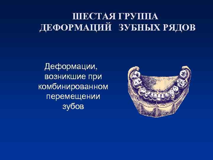 ШЕСТАЯ ГРУППА ДЕФОРМАЦИЙ ЗУБНЫХ РЯДОВ Деформации, возникшие при комбинированном перемещении зубов 