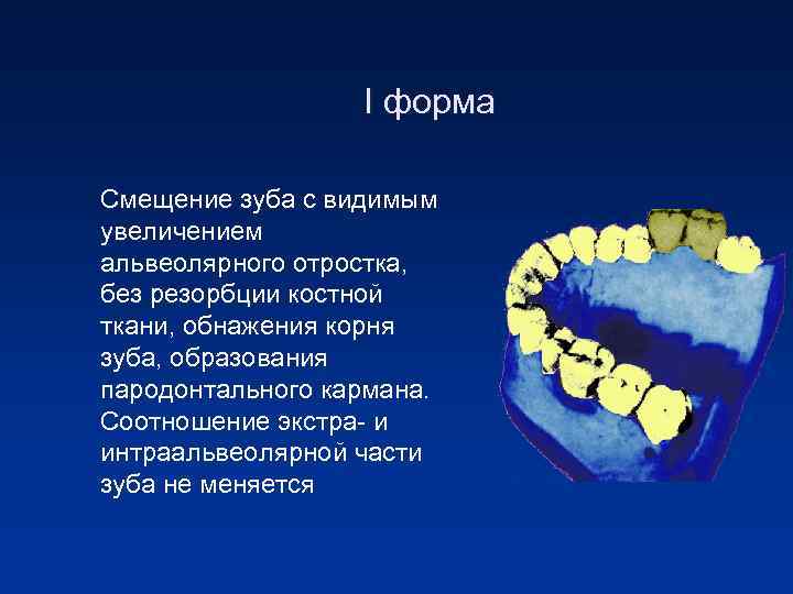 I форма Смещение зуба с видимым увеличением альвеолярного отростка, без резорбции костной ткани, обнажения