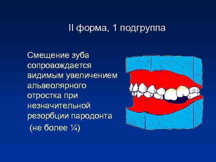 II форма, 1 подгруппа Смещение зуба сопровождается видимым увеличением альвеолярного отростка при незначительной резорбции