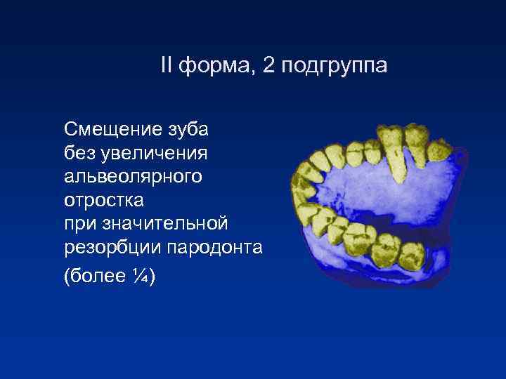 II форма, 2 подгруппа Смещение зуба без увеличения альвеолярного отростка при значительной резорбции пародонта