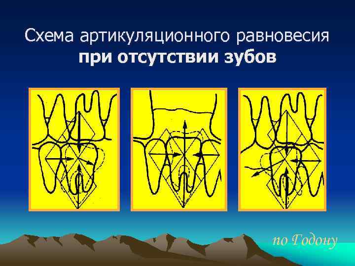 Схема артикуляционного равновесия при отсутствии зубов по Годону 