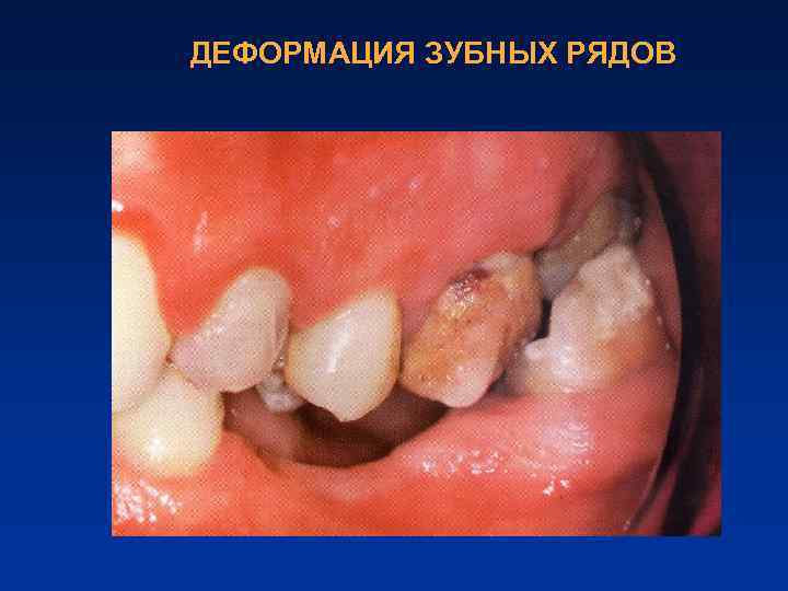 ДЕФОРМАЦИЯ ЗУБНЫХ РЯДОВ 