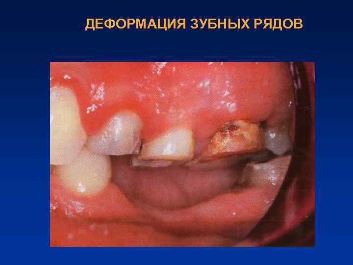 ДЕФОРМАЦИЯ ЗУБНЫХ РЯДОВ 