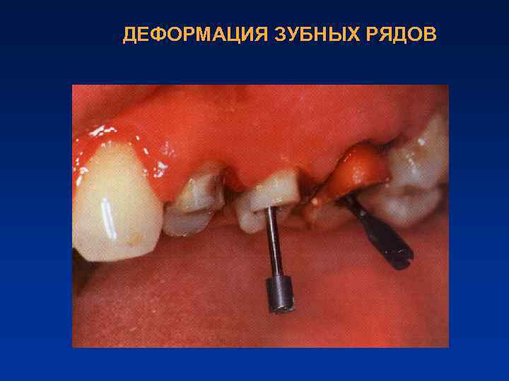 ДЕФОРМАЦИЯ ЗУБНЫХ РЯДОВ 