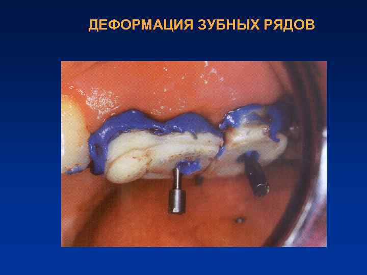 ДЕФОРМАЦИЯ ЗУБНЫХ РЯДОВ 