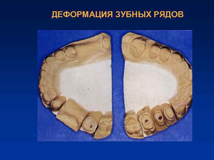 ДЕФОРМАЦИЯ ЗУБНЫХ РЯДОВ 