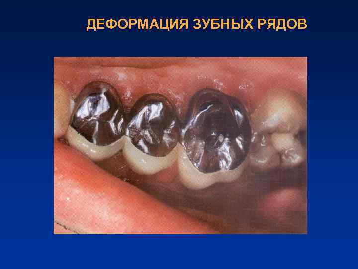 ДЕФОРМАЦИЯ ЗУБНЫХ РЯДОВ 