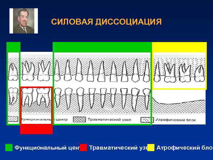 СИЛОВАЯ ДИССОЦИАЦИЯ Функциональный центр Травматический узел Атрофический блок 