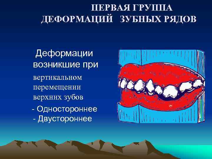  ПЕРВАЯ ГРУППА ДЕФОРМАЦИЙ ЗУБНЫХ РЯДОВ Деформации возникшие при вертикальном перемещении верхних зубов -