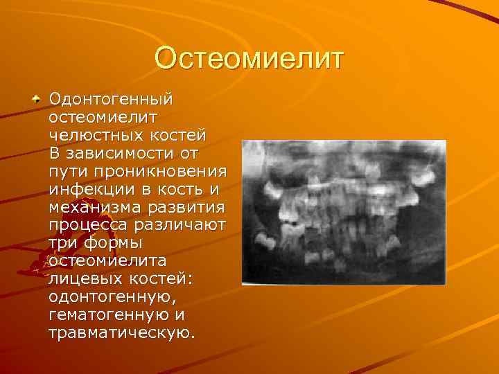 Остеомиелит Одонтогенный остеомиелит челюстных костей В зависимости от пути проникновения инфекции в кость и