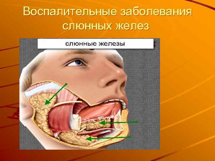 Воспалительные заболевания слюнных желез 