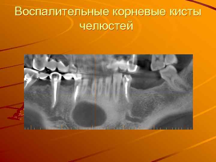 Воспалительные корневые кисты челюстей 