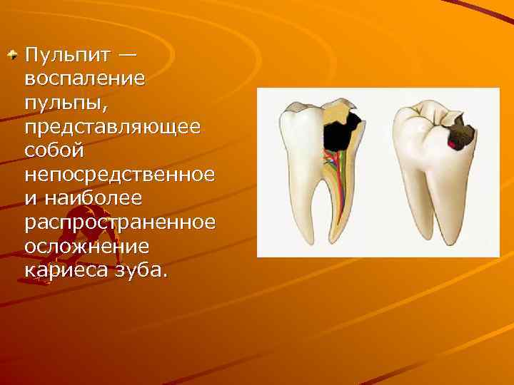 Пульпит — воспаление пульпы, представляющее собой непосредственное и наиболее распространенное осложнение кариеса зуба. 