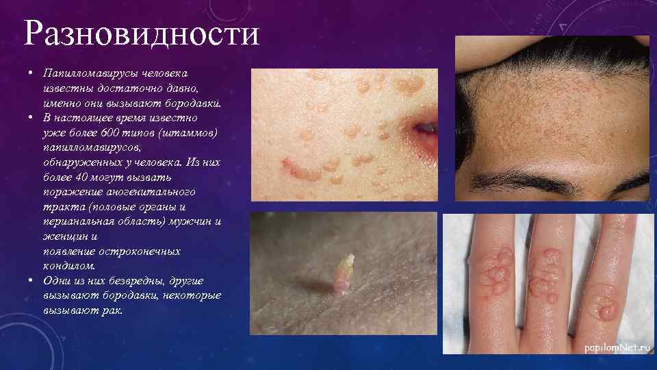 Разновидности • Папилломавирусы человека известны достаточно давно, именно они вызывают бородавки. • В настоящее