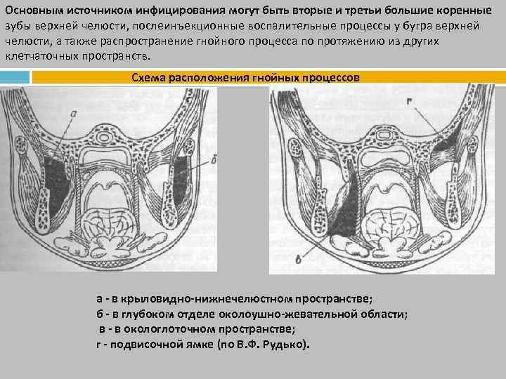 Основным источником инфицирования могут быть вторые и третьи большие коренные зубы верхней челюсти, послеинъекционные