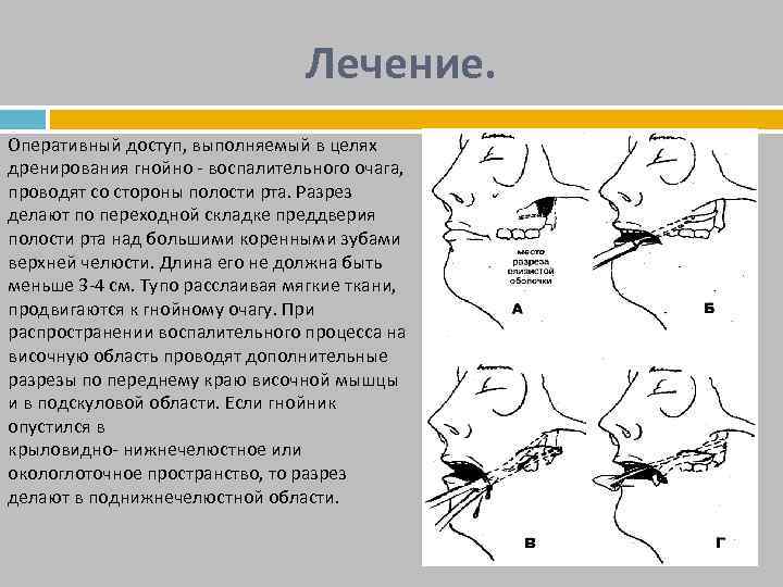 Лечение. Оперативный доступ, выполняемый в целях дренирования гнойно - воспалительного очага, проводят со стороны