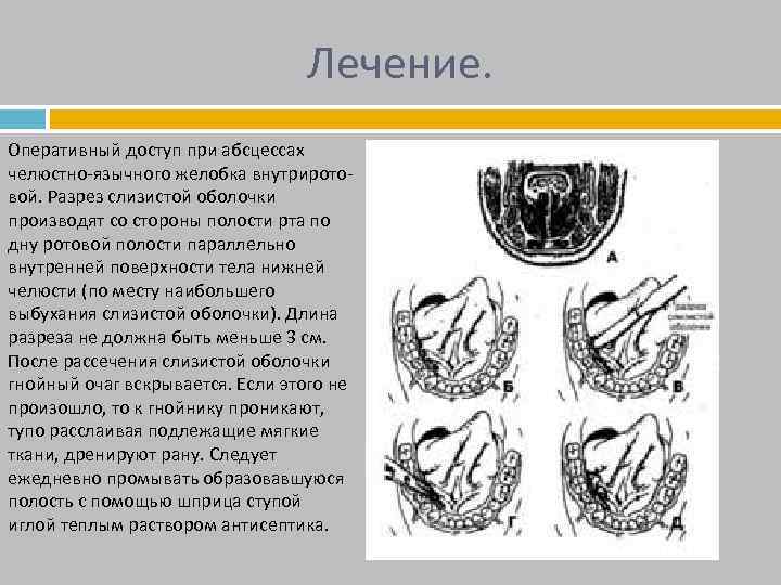 Лечение. Оперативный доступ при абсцессах челюстно-язычного желобка внутриротовой. Разрез слизистой оболочки производят со стороны