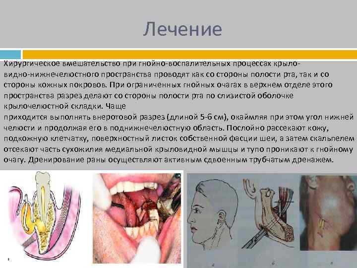 Лечение Хирургическое вмешательство при гнойно-воспалительных процессах крыловидно-нижнечелюстного пространства проводят как со стороны полости рта,