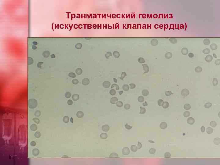 Травматический гемолиз (искусственный клапан сердца) 