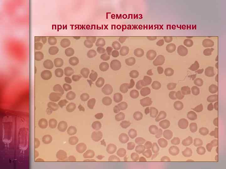 Гемолиз при тяжелых поражениях печени 