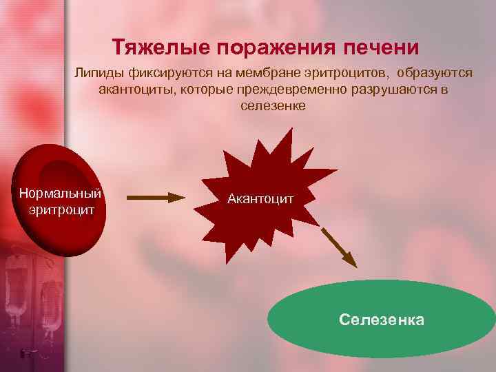 Тяжелые поражения печени Липиды фиксируются на мембране эритроцитов, образуются акантоциты, которые преждевременно разрушаются в