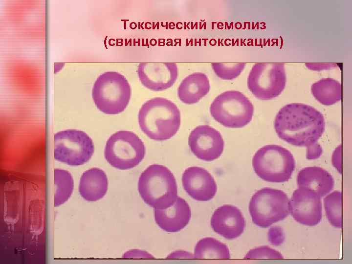 Токсический гемолиз (свинцовая интоксикация) 