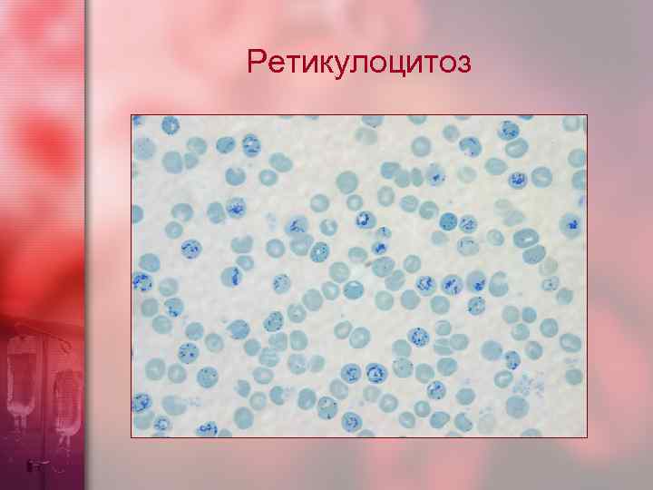 Ретикулоцитоз 