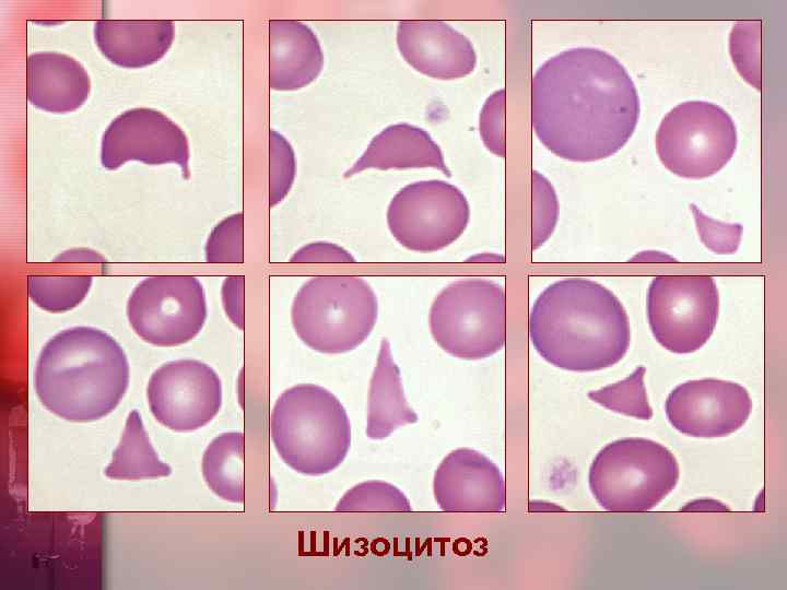 Шизоцитоз 