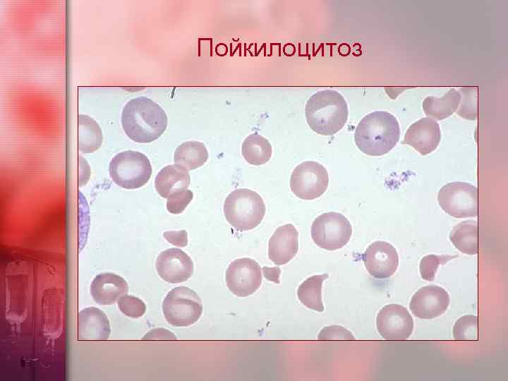 Пойкилоцитоз 