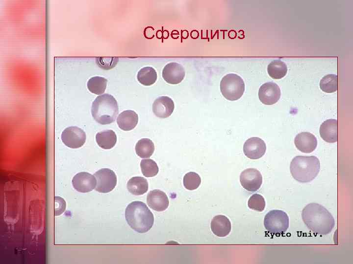 Сфероцитоз 