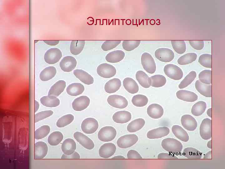 Эллиптоцитоз 