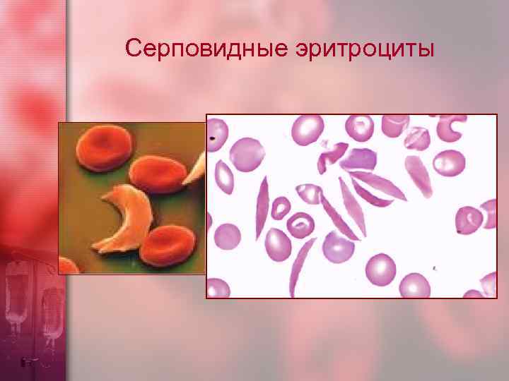 Серповидные эритроциты 