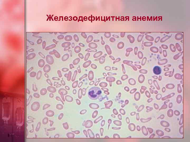 Железодефицитная анемия 