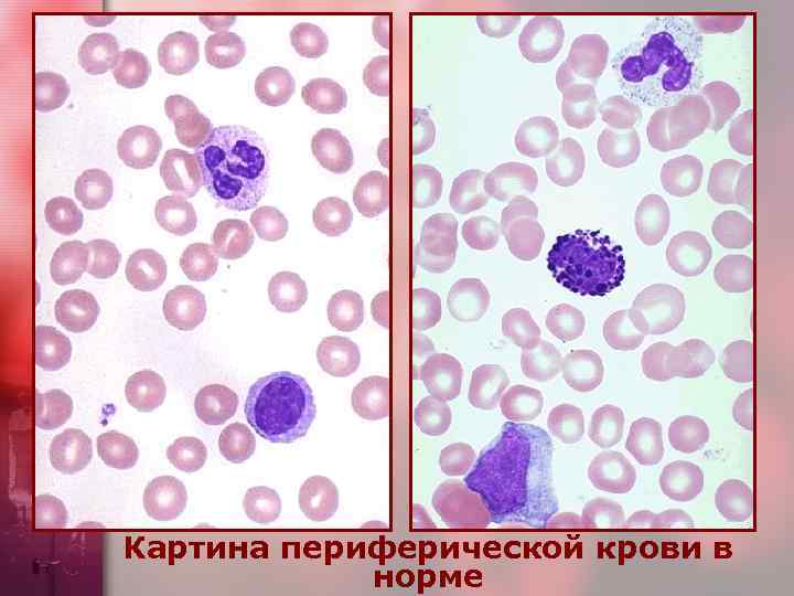 Картина периферической крови