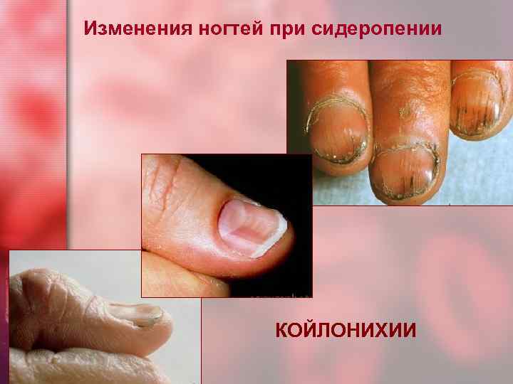 Изменения ногтей при сидеропении КОЙЛОНИХИИ 