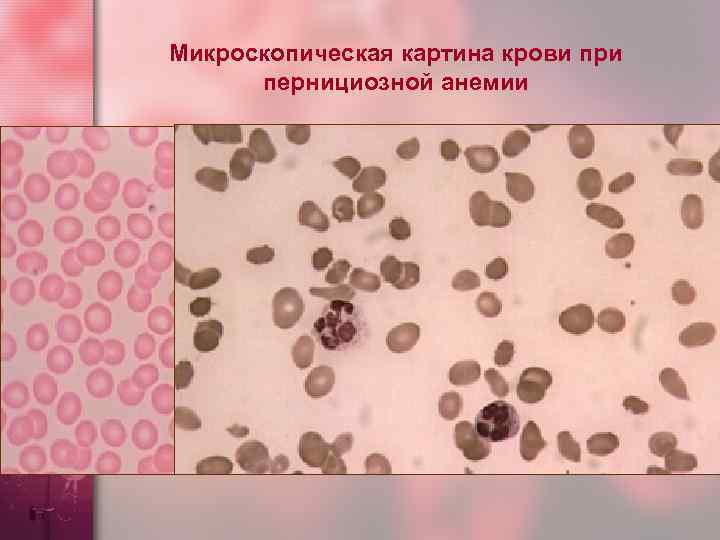 Микроскопическая картина крови при пернициозной анемии 