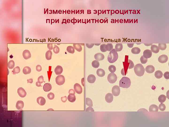 Изменения в эритроцитах при дефицитной анемии Кольца Кабо Тельца Жолли 