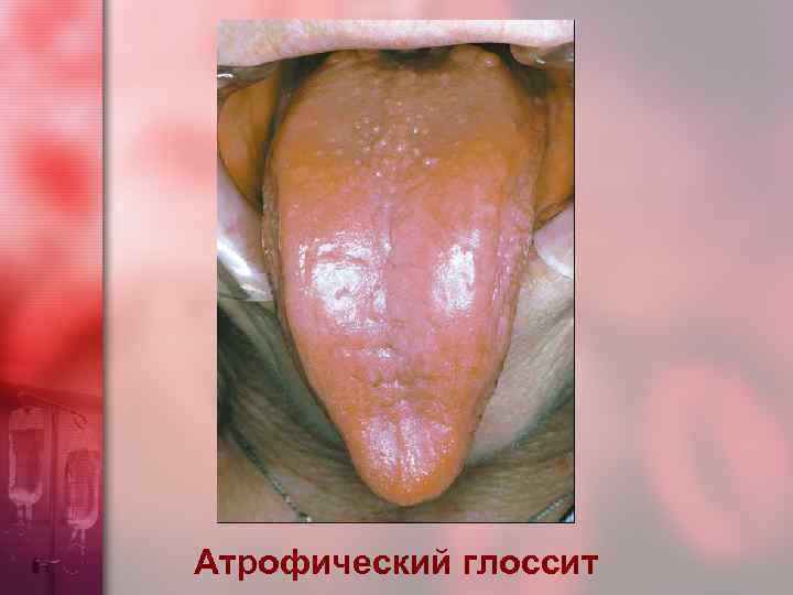 Атрофический глоссит 