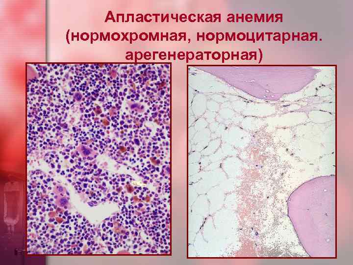 Апластическая анемия (нормохромная, нормоцитарная. арегенераторная) 