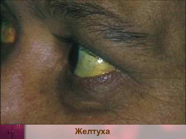 Желтуха 