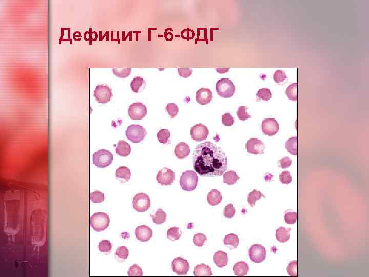 Дефицит Г-6 -ФДГ 