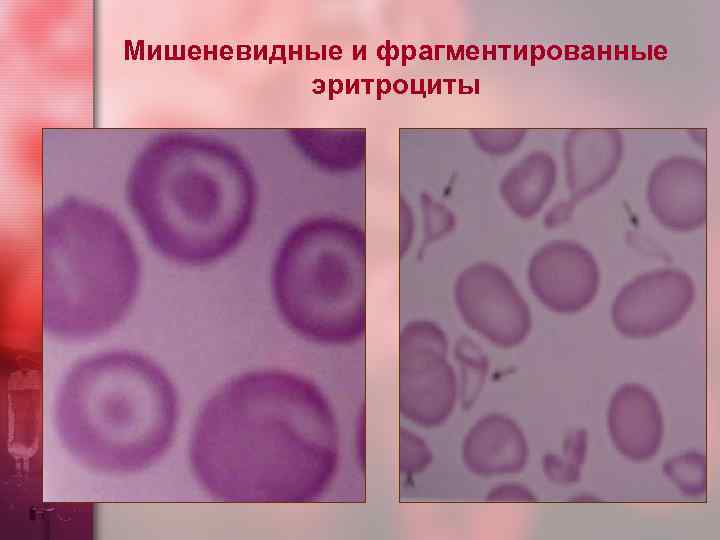 Мишеневидные и фрагментированные эритроциты 