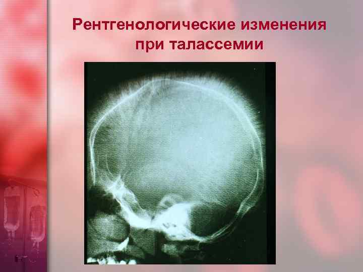 Рентгенологические изменения при талассемии 