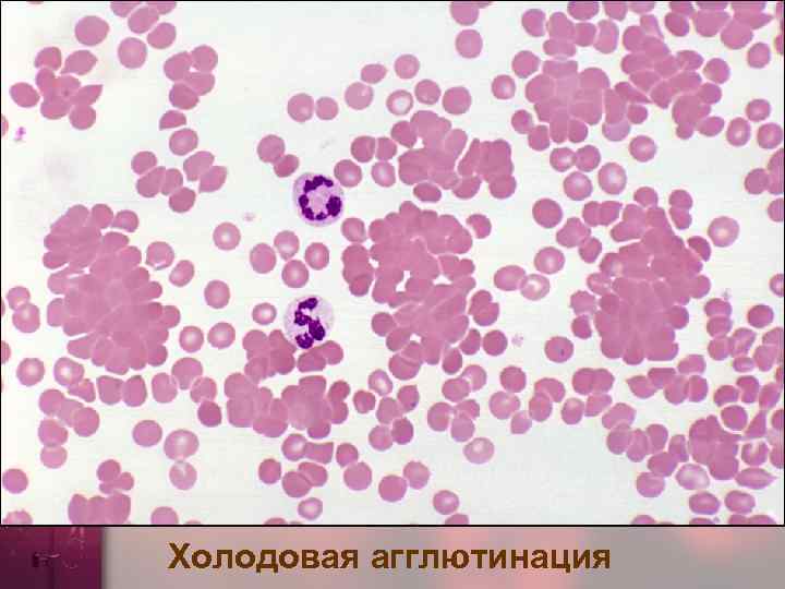 Холодовая агглютинация 