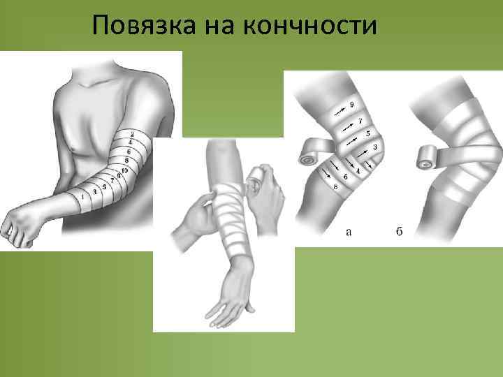 Повязка на кончности 