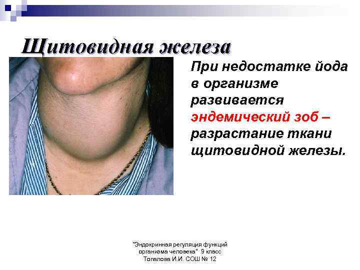 Щитовидная железа При недостатке йода в организме развивается эндемический зоб – разрастание ткани щитовидной