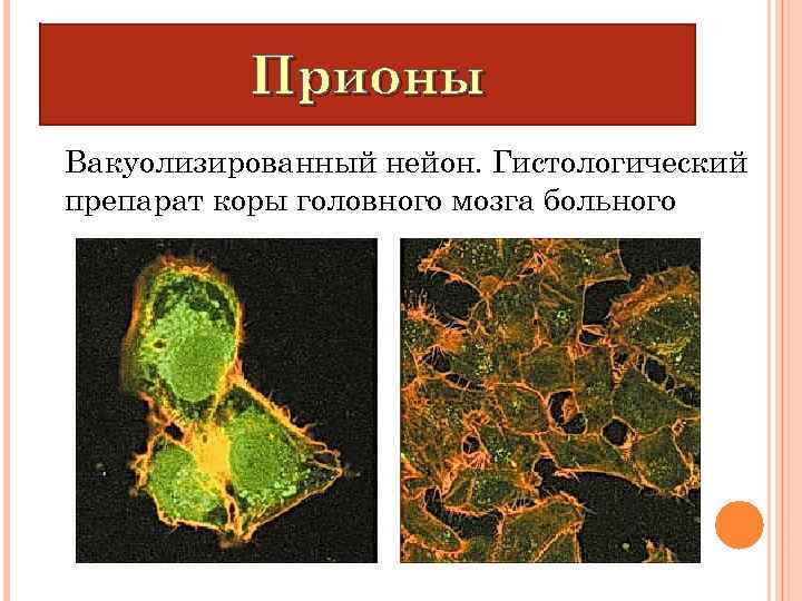 Прионы Вакуолизированный нейон. Гистологический препарат коры головного мозга больного 